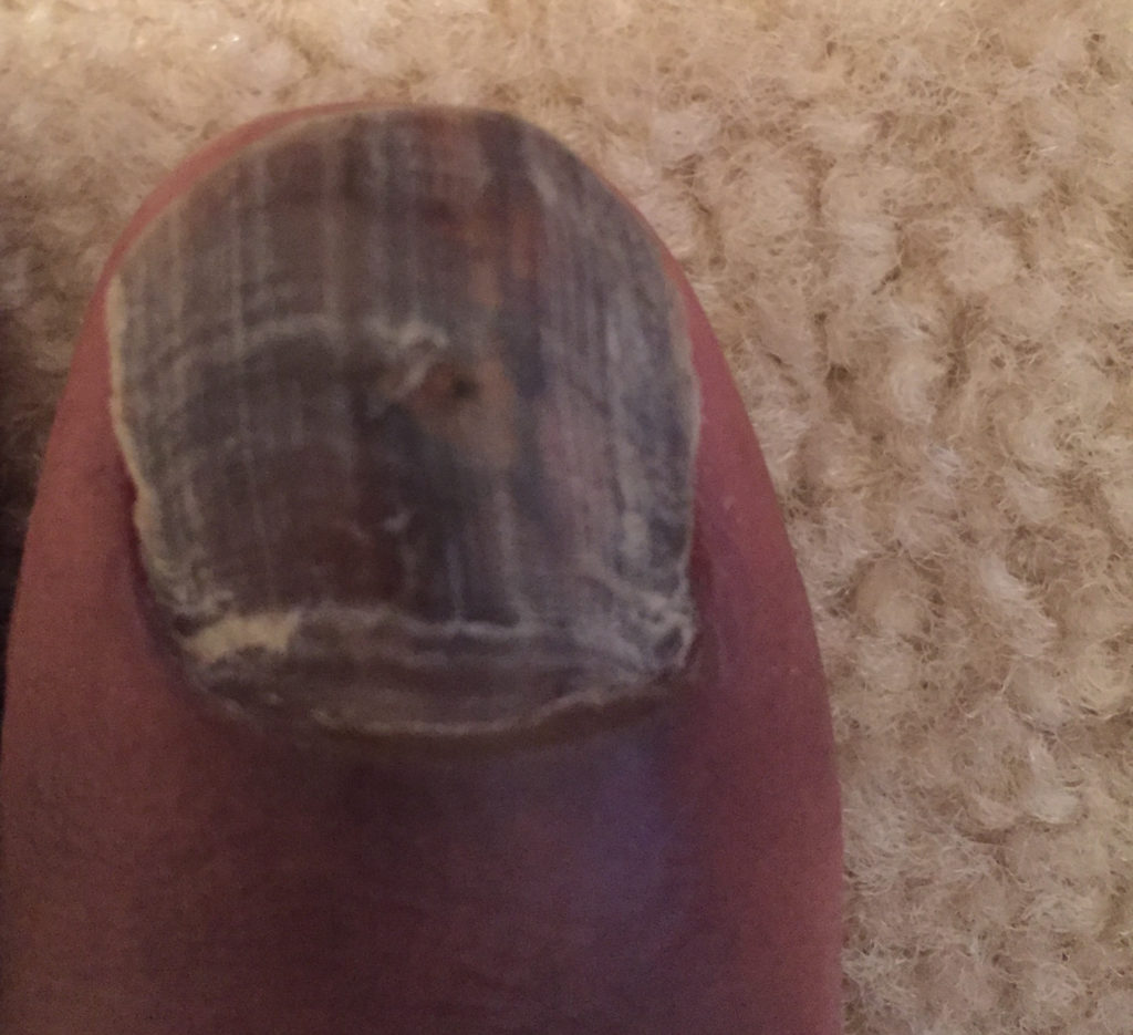 my-toe-nail