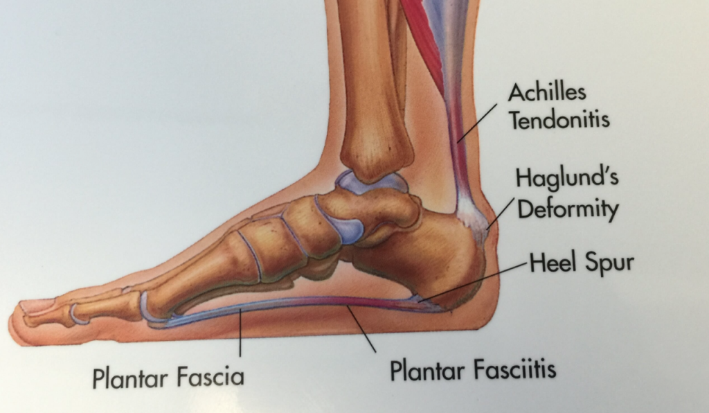 plantarfasciitis